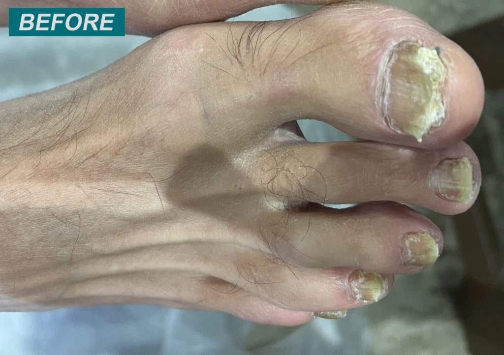 Foot Care Thick Nail treatment in Faversham