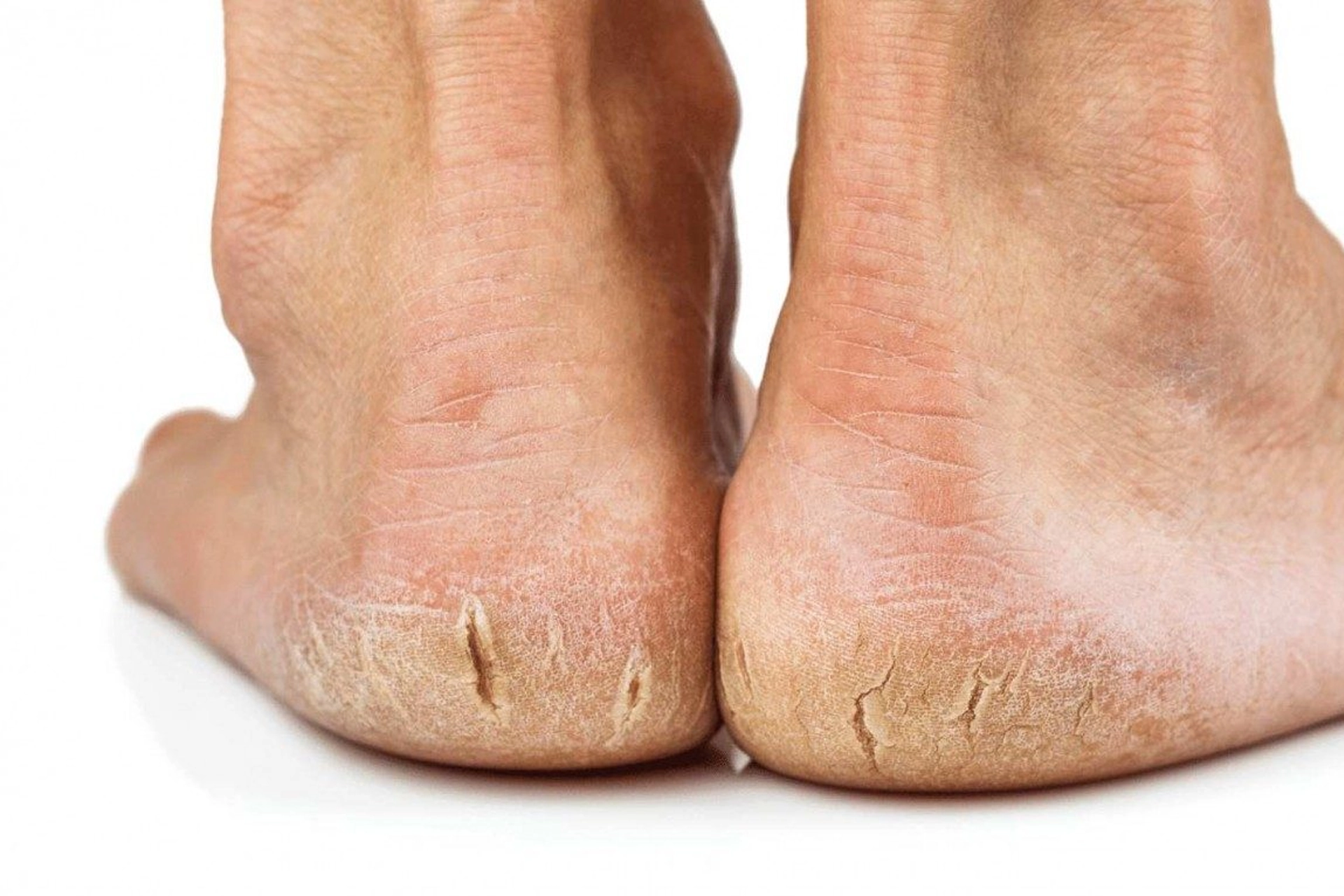 picture of mans cracked heels - chiropodist - podiatrist faversham