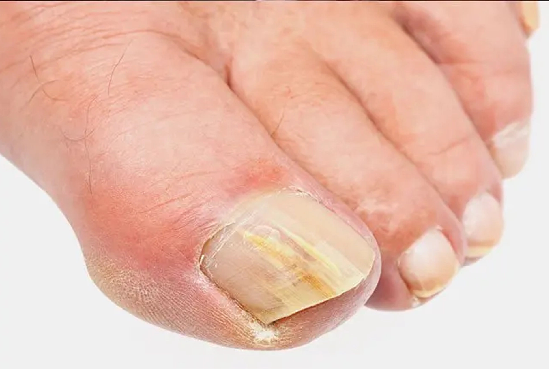 thick nails foot care faversham