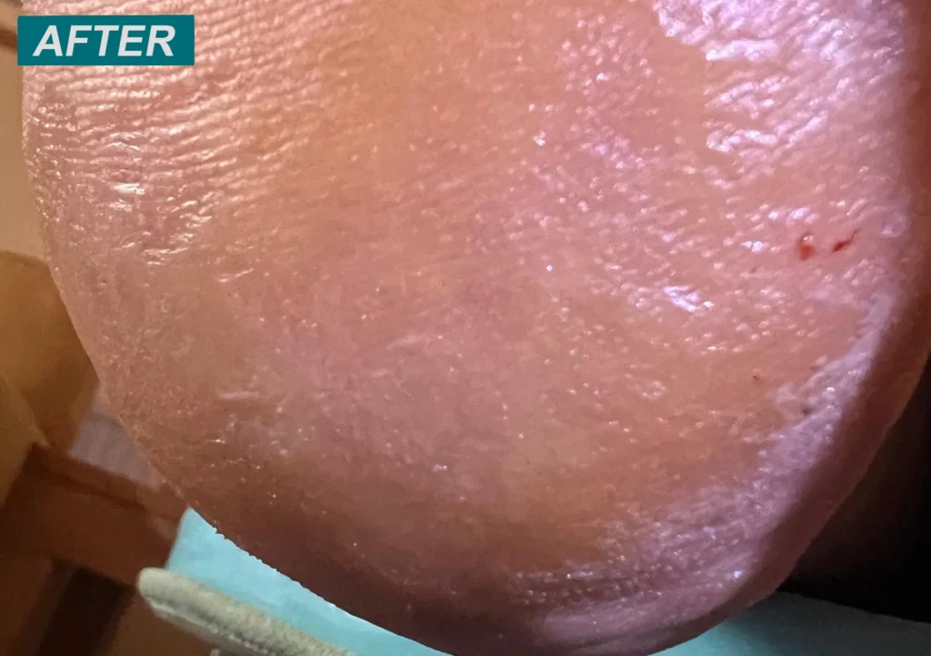 heel post treatment - faversham foot clinic
